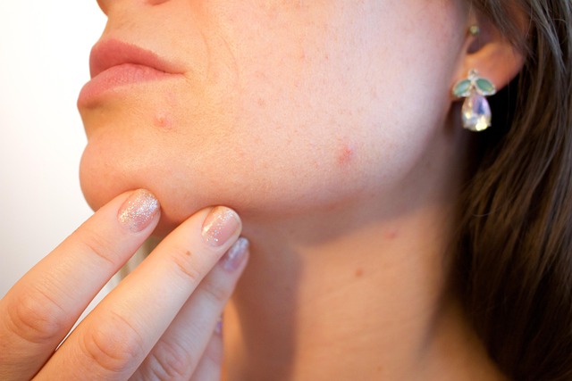 Akne und Hormone: Erfahren Sie alles über die hormonellen Ursachen von Hautunreinheiten und wie Sie Ihr inneres Gleichgewicht für eine reine Haut wiederfinden.